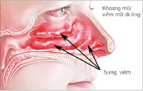 Zentason Chống viêm mũi dị ứng