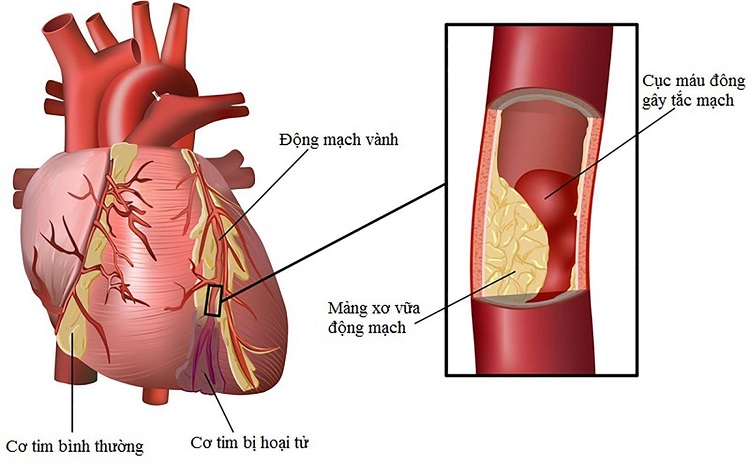 Thiếu máu cơ tim về lâu dài có thể khiến cơ tim bị hoại tử.