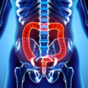 viêm loét đại tràng