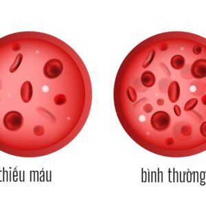 thiếu máu