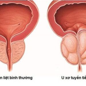 u sơ tuyến tiền liệt