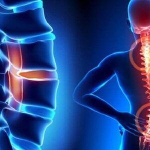 thoái hóa đốt sống